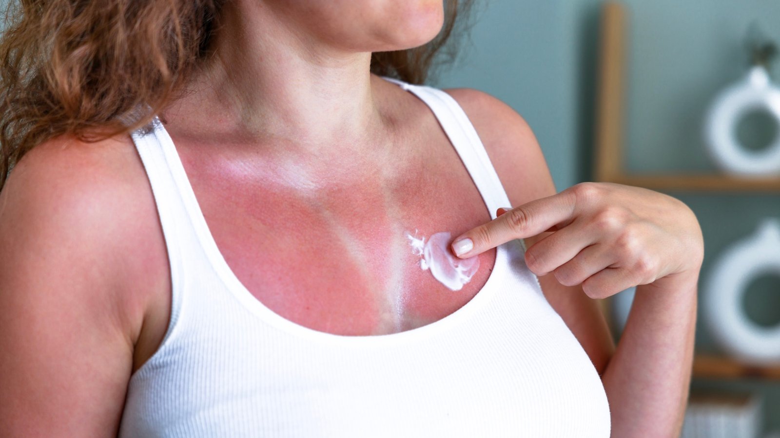 Si después de tomar el sol pasa esto, debes acudir al médico